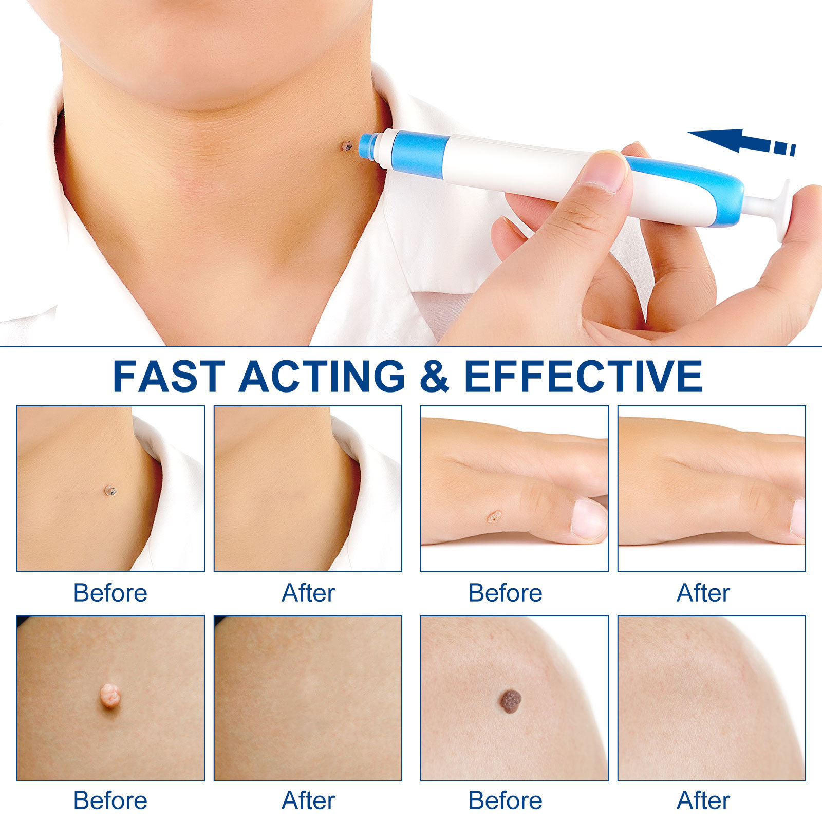 2-IN-1 Auto Skin Tag Removal K - Skincare Ingredients Checker บทวิจารณ์และราคา